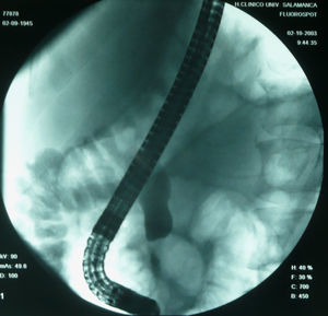 Colangiopancreatografía retrógrada endoscópica (paciente n.o 3): stent de drenaje por estenosis de colédoco distal de origen neoplásico dependiente del páncreas.