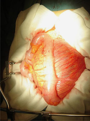 Imagen del campo quirúrgico previo a la resección de la muestra, corte laparotomía xifosuprapúbica. Se aprecia el colon sigmoide en primer plano.