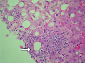 Doughnut granuloma (flecha) junto a un área de colestasis (hematoxilina-eosina (HE)-400×).