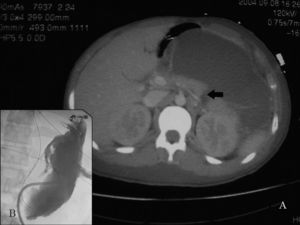 (A) Abdominal CT scan suggests a transected pancreas in the corporocaudal junction (black arrow). Pseudocyst is also seen. (B) Pseudocystography of drained cavity, eight days later.