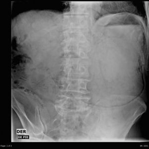 Radiografía abdominal anteroposterior con dilatación gástrica e imagen indicativa de enfisema gástrico.