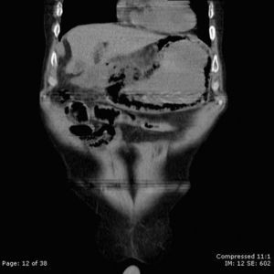 Tomografía abdominal con reconstrucción coronal que evidencia aire en la pared gástrica.