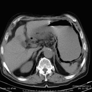 Tomografía abdominal en cortes axiales que muestran la extensión de la neumatosis gástrica.