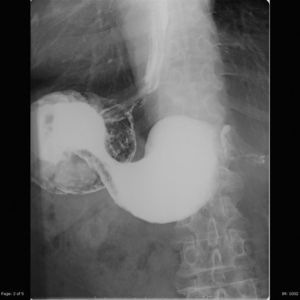Tránsito baritado esófago-estómago-duodeno con retardo en el vaciamiento gástrico y estenosis pilórica.