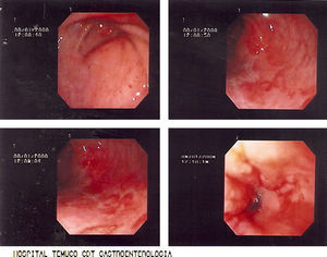 Endoscopia digestiva alta de control con obstrucción pilórica y duodenal con ectasia gástrica.