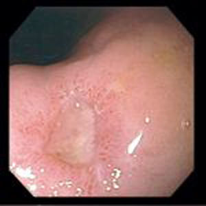 Endoscopia: úlcera profunda de aspecto indeterminado en el cuerpo gástrico, origen de la hemorragia.