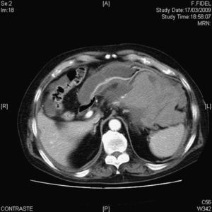 Imagen de la tomografía computarizada en la que se aprecia gran hemoperitoneo, sin poderse determinar el origen de éste.
