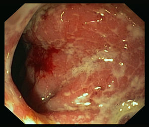 Imagen endoscópica que muestra mucosa de recto edematosa y friable con erosiones superficiales y úlceras profundas.