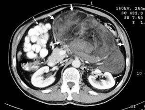 Contrast-enhanced axial CT scan showing a large, high-grade retroperitoneal liposarcoma (thick arrows) with areas of low density due to degeneration or necrosis, and extreme displacement of adjacent organs (thin arrows) [patient 10].