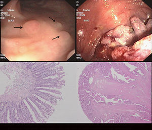 Endoscopy view of multiple pale sessile polyps (upper left) and the adenocarcinoma of the ascending colon (upper right); histology of a hyperplastic polyp (bottom left) and the invasive mucinous adenocarcinoma (bottom right).