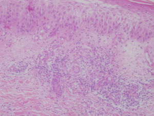 Histología de biopsia cutánea que muestra un infiltrado inflamatorio crónico con granulomas no caseificantes.