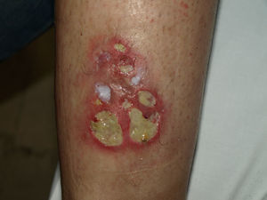 ECM: lesión cutánea inicial.