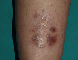 ECM: lesión cutánea tras concluir la fase de inducción del tratamiento con infliximab.