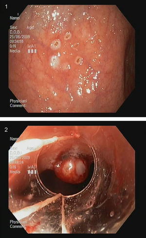 Pequeño tumor carcinoide cuyos márgenes se marcan con asa de diatermia; posteriormente se coloca una banda sobre la lesión.