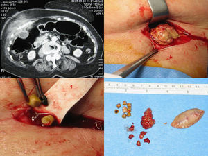 Mosaico de imágenes en las que se aprecia la lesión en la tomografía y distintos momentos del acto y pieza quirúrgica.