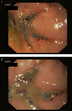 Imagen endoscópica a retrovisión de lesión marronacea negruzca inespecífica en fundus gástrico.