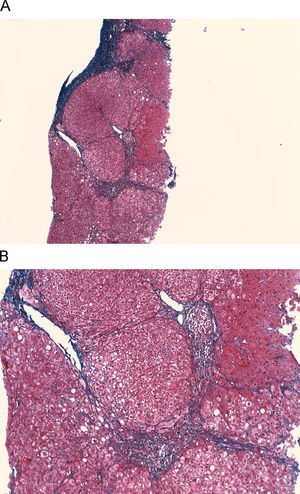 Tinción con tricrómico de Masson de la biopsia hepática realizada en 1987: A) Imagen macroscópica en la que se pueden apreciar puentes de fibrosis muy importante (×40). B) Imagen (×200) en la que se identifican septos fibrosos portoportales centroportales, con inflamación crónica.