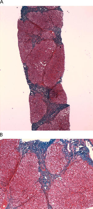 Tinción con tricrómico de Masson de la biopsia hepática realizada en 1991: A) Imagen macroscópica en la que se ve cirrosis micro-macronodular (×40). B) Imagen (×200) en la que se identifican una clara desestructuración del parénquima hepático, inflamación portal y nódulos de regenración.