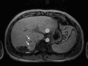 Resonancia magnética nuclear hepática que muestra la presencia de varias lesiones nodulares que miden entre 15–30mm de diámetro compatibles con estadio BCLC B.