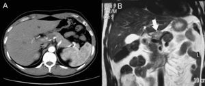 Lesión sólida pancreática en íntimo contacto con el tronco celíaco visualizada en TC (A) y RMN (B).