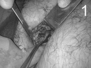 Imagen de la cirugía. Se visualiza perforación del íleon terminal con salida de la prótesis plástica a través de la incisión de Pfannestiel de 5cm guiada previamente por laparoscopia.