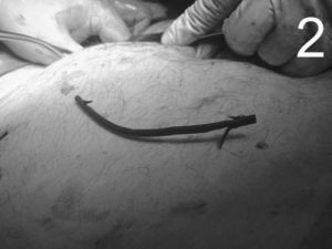 Imagen de la cirugía. Prótesis plástica sobre la pared abdominal luego del cierre de la perforación intestinal.