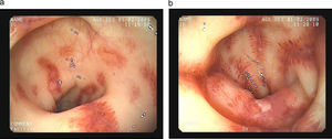 (a and b) Small colonic ulcers covered by fibrin and perilesional inflammation with a trend to stenose the lumen.