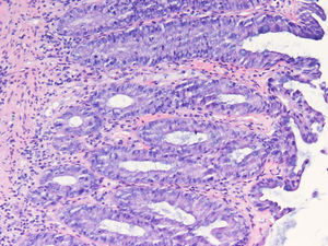 Normal epithelium with a chronic and unspecific inflammatory infiltrate in the crypts.