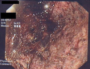 Imagen endoscópica de antro gástrico. Destacan restos hemáticos negruzcos sobre una mucosa granular extremadamente friable de aspecto necrótico.