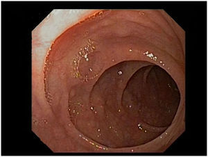 Imagen de la enteroscopia que muestra una mucosa suavemente nodular compatible con atrofia vellositaria.