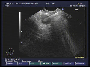 Punción aspiración con aguja fina de tumor neuroendocrino localizado a nivel de cuerpo de páncreas.