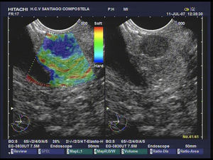 Tumor neuroendocrino maligno no funcionante, localizado a nivel de cabeza de páncreas, con patrón elastrogáfico homogéneo azul.