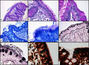 Pies de figura El estudio microscópico con hematoxilina-eosina (figura a) muestra una mucosa de colon con un escaso infiltrado inflamatorio de tipo crónico en lámina propia y destaca un engrosamiento basófilo, PAS positivo (figura b,c) en el borde en cepillo de la mucosa. La realización de tinciones especiales giemsa (figuras d,e), Grocott (figuras f,g) y tinción de Plata ponen de manifiesto la presencia de organismos filamentosos espirales dispuestos paralelos entre sí en el borde luminar del epitelio superficial del colon. La tinción de Warthin-Starry (figuras h,i) permitió identificar los organismos filamentosos-espirales demostrando la presencia de espiroquetas.