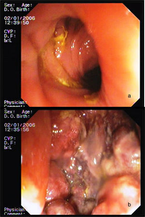Colonoscopia. a) a través del cabo distal del estoma: colon sigmoide normal. b) a través del cabo proximal: signos de isquemia mucosa.