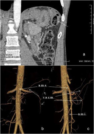 Angio TC. a) Engrosamiento mural en ángulo esplénico de colon (flecha). b) Visión frontal. c) Visión lateral. a.m.i.: fina arteria mesentérica inferior; a.m.s.: arteria mesentérica superior; r.a.c.m.: ramas de la arteria cólica media irrigando el ángulo esplénico de colon.