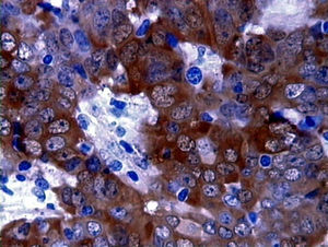 Carcinoma neuroendocrino de células pequeñas de colon con coloración enolasa neuroespecífica.