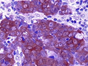 Carcinoma neuroendocrino de células pequeñas de colon con coloración sinaptofisina.