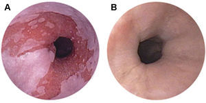A) Imagen endoscópica del esófago de Barrett. El epitelio escamoso normal del esófago es sustituido por epitelio columnar. B) Aspecto del esófago de Barrett totalmente reepitelizado por neoepitelio escamoso 8 semanas después de la ablación.