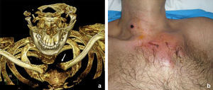 a) Osteomielitis en articulación esternoclavicular izquierda. b) Celulitis cervical derecha y pectoral izquierda.