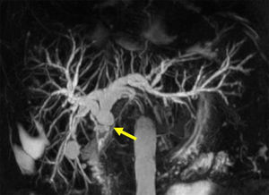Magnetic resonance cholangiography showing an anastomotic stricture in a patient after liver transplantation. Note the short segment narrowed (arrow) with proximal bile duct dilation.