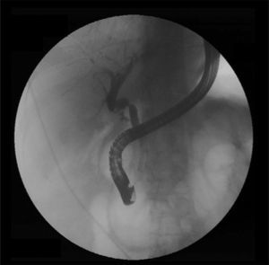 Anastomotic biliary stricture as seen with endoscopic retrograde cholangiography. The image shows the characteristic cholangiographic appearance of an anastomotic stricture with short narrowing at the anastomotic site.