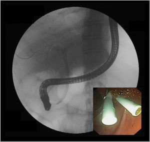 Therapy of anastomotic biliary strictures. Note the endoscopic retrograde cholangiography images of two plastic stents placed side by side after dilation of an anastomotic biliary stricture.