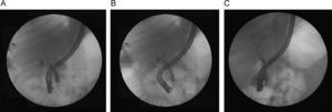 Endoscopic retrograde cholangiography images in a patient with an anastomotic bile leak after T-tube removal (A), after plastic stent placement in the bile duct (B) and 2 months later with no evidence of leak after the stent removal (C).
