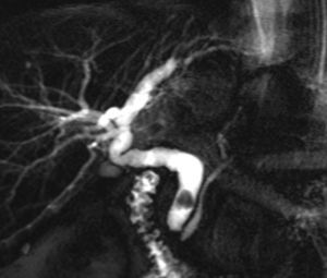 Magnetic resonance cholangiography showing a common bile duct stone with bile duct dilation in a liver transplant recipient.