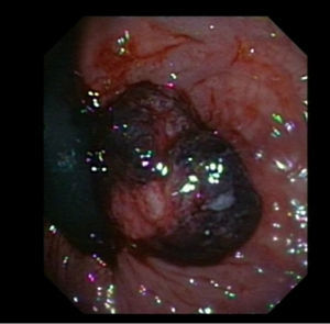 Lesión polipoide congestiva en el margen anal interno compatible con melanoma anorrectal.