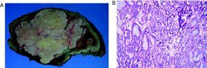 A) Foto macroscópica de la lesión tumoral hepática con las características descritas en el texto, al corte de la pieza. B) Foto microscópica en H/E 10x, donde se observa la proliferación tumoral dispuesta en túbulos inmersos en estroma fibrosa densa.