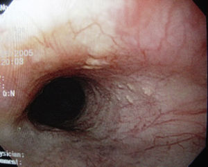 Presencia de lesiones nodulares de color amarillento, de 4-5mm de diámetro, localizadas en la mucosa del tercio medio del esófago, compatibles con glándulas sebáceas ectópicas.