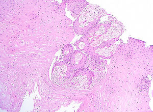 Glándulas sebáceas maduras, compuestas por lobulillos de células grandes ovoides con citoplasma claro, vacuolado, núcleos pequeños, centrales de cromatina sólida, delimitadas por células de tamaño pequeño e intermedio, aplanadas o cúbicas, con citoplasma eosinófilo (células de reserva). Las glándulas se encuentran inmersas en el epitelio plano estratificado del esófago (tinción H-E).