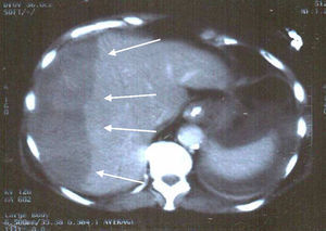 La TC abdominal mostró la presencia de un hematoma hepático de 16×6,5×21cm (flechas).