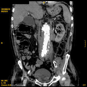 TAC de abdomen. Prótesis aorto-ilíaca con presencia de gran colección con gas por fístula aorto-entérica.